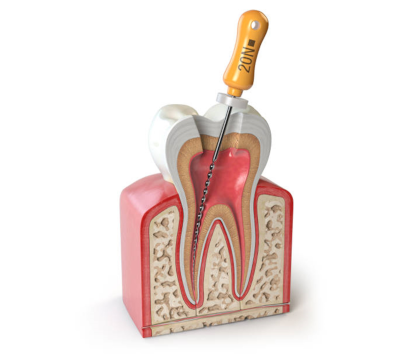 Endodonzia